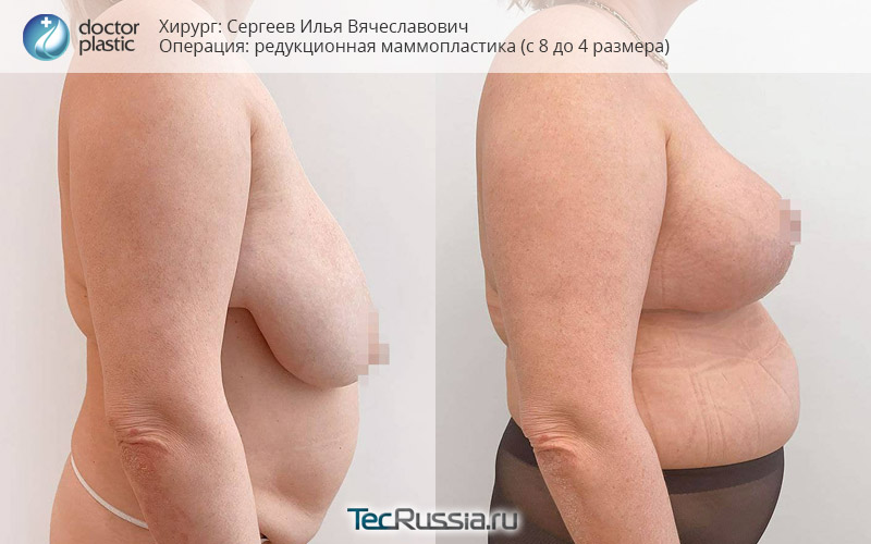 фото до и после редукционной маммопластики