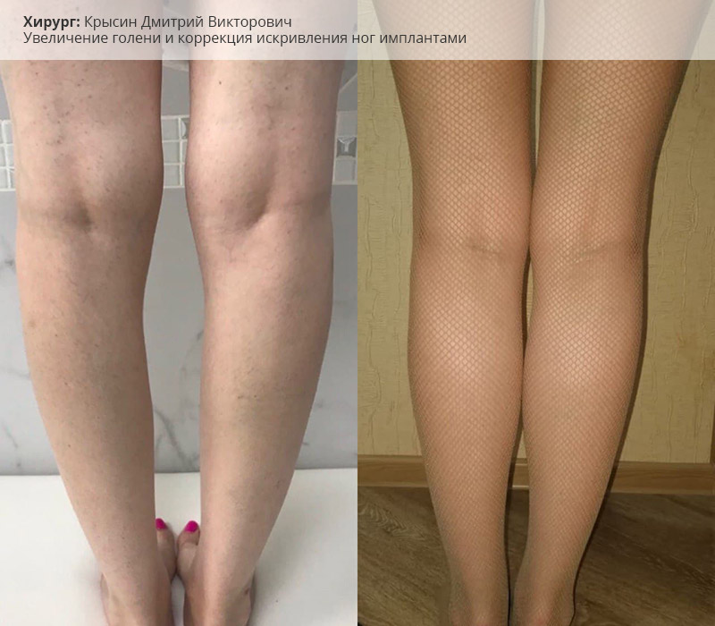 фото до и после пластики голеней и устранения кривизны ног