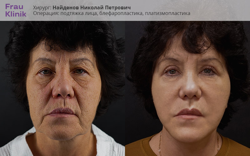 швы после подтяжки лица, фото до и после пациентки доктора Найденова