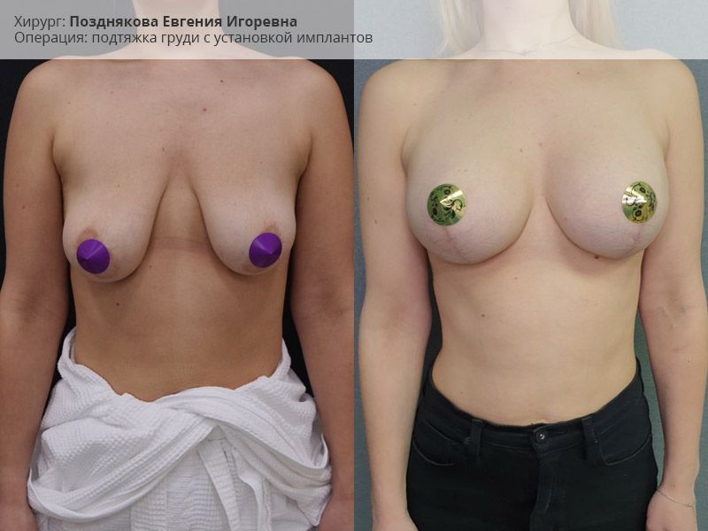 Фото до и после мастопексии на имплантах, хирург Е.Позднякова