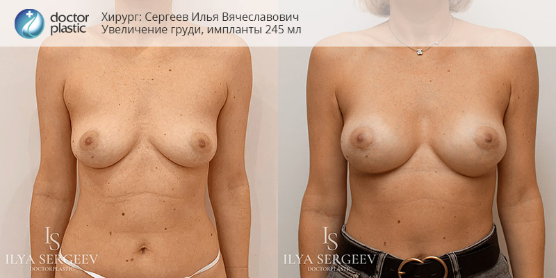 установка грудных имплантов, хирург Илья Сергеев
