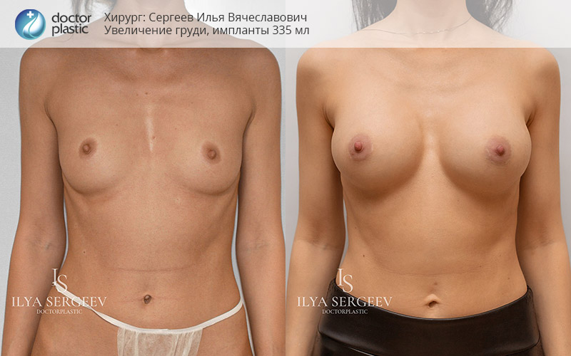 фото до и после маммопластики, хирург И.Сергеев
