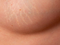 Растяжки после пластики груди: важные нюансы операции