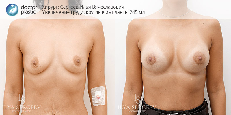 фото до и после увеличения груди имплантами 240 мл, хирург Сергеев И.В.
