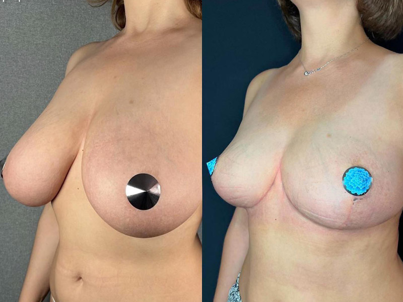 фото до и после редукционной маммопластики