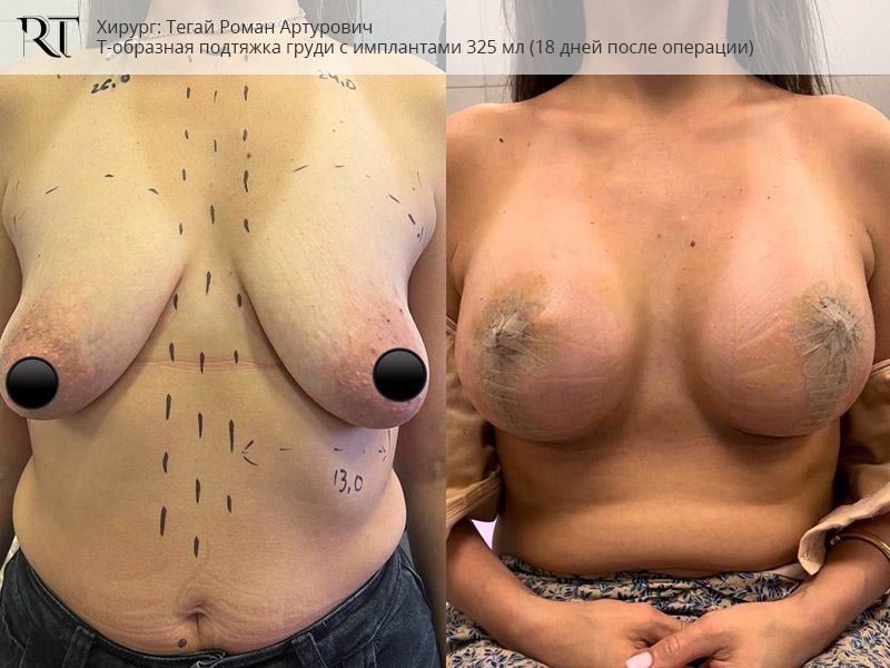 фото до и после т-образной подтяжки груди с имплантами 325 мл